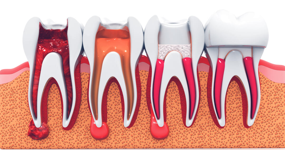 Gy k rkezel s rak Budapesten a RoseDental Fog szaton